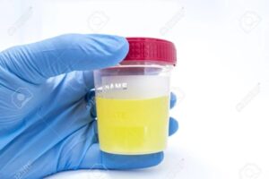 a blue gloved hand holding a urine sample cup