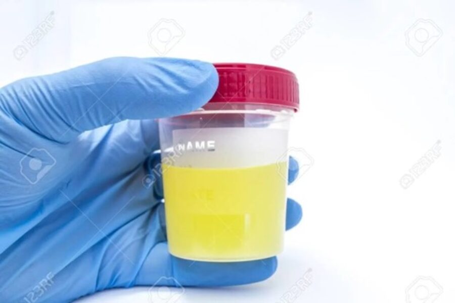 a blue gloved hand holding a urine sample cup