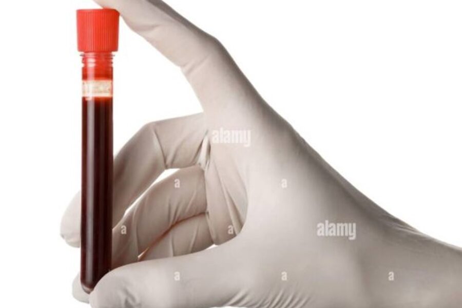 picture of vial of blood drawn from my port to check for low potassium